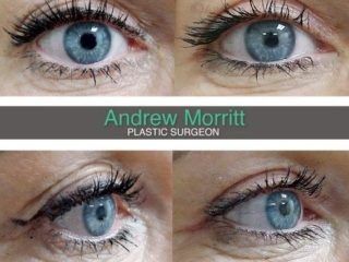 Upper blepharoplasty eyelid surgery Sheffield