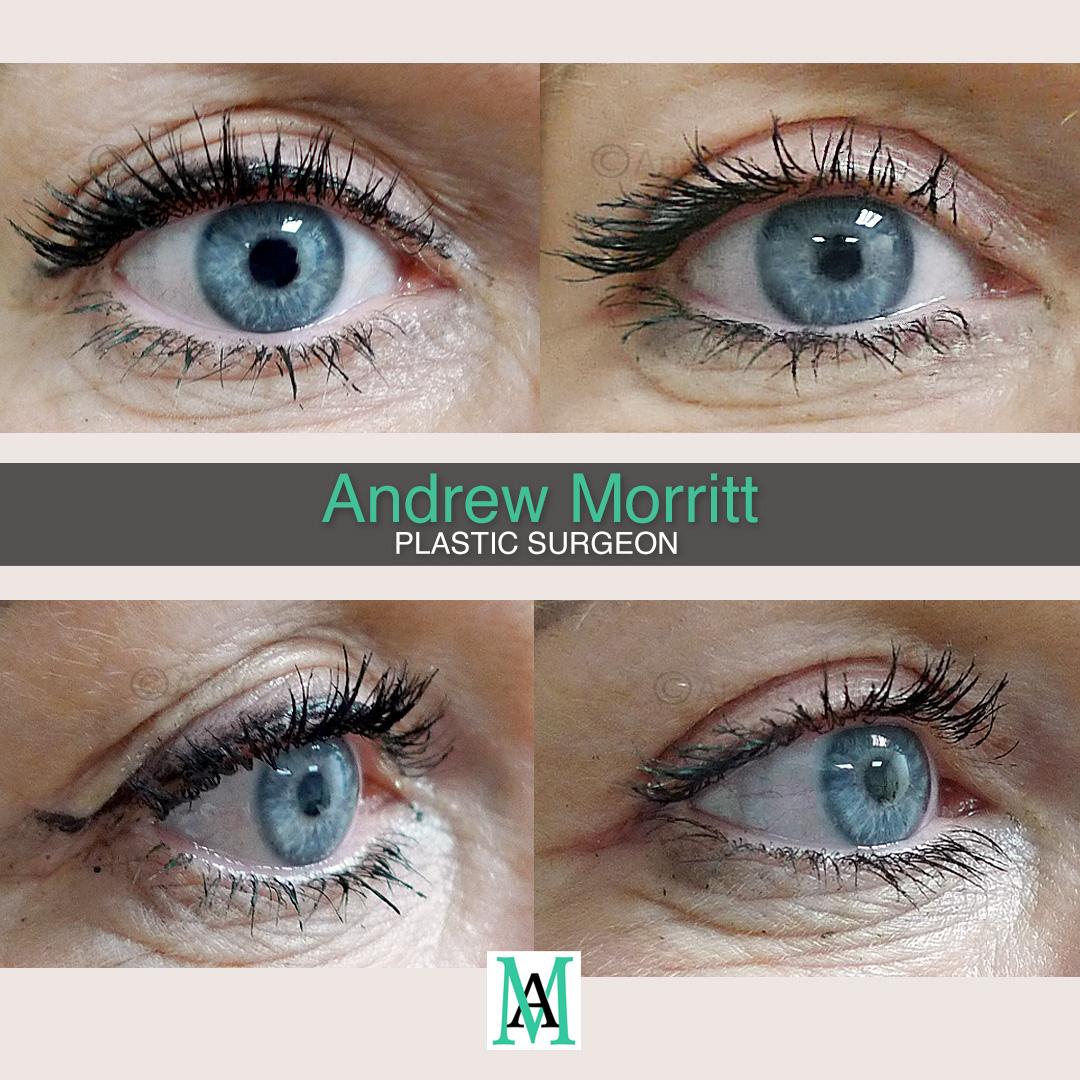 photos showing appearances before and after upper blepharoplasty eyelid eyebag surgery sheffield