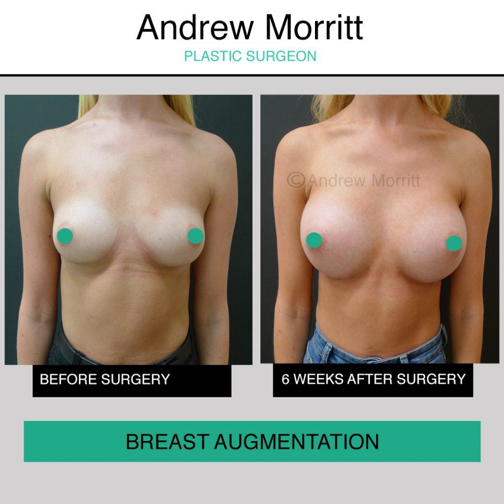 breast augmentation enlargement sheffield 1 breast augmentation enlargement sheffield 1