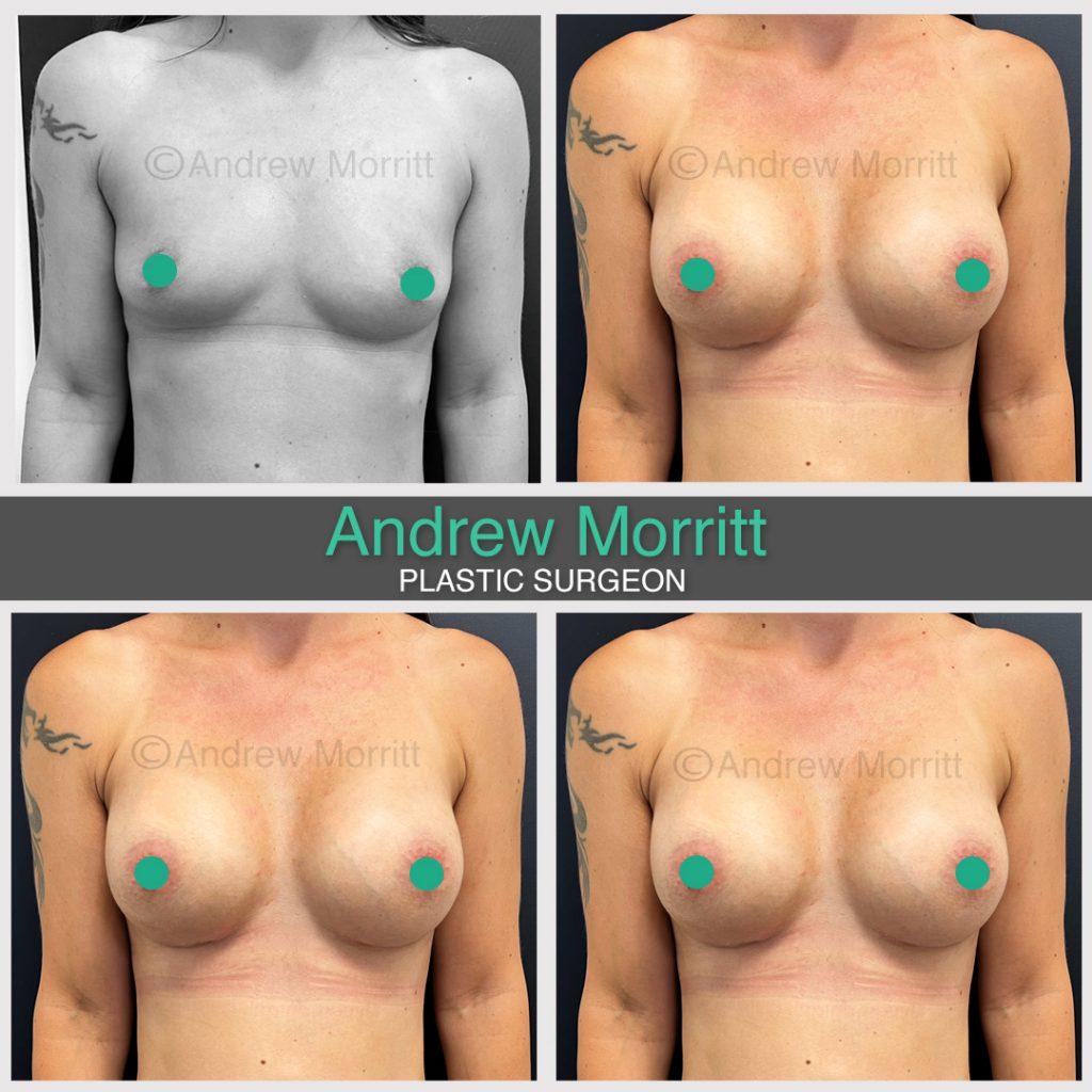 breast-augmentation-21 Before and after breast augmentation