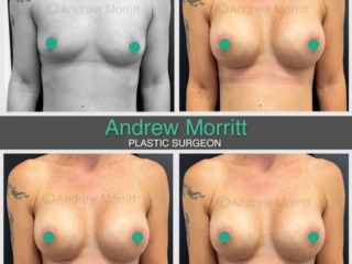breast-augmentation-21 Before and after breast augmentation