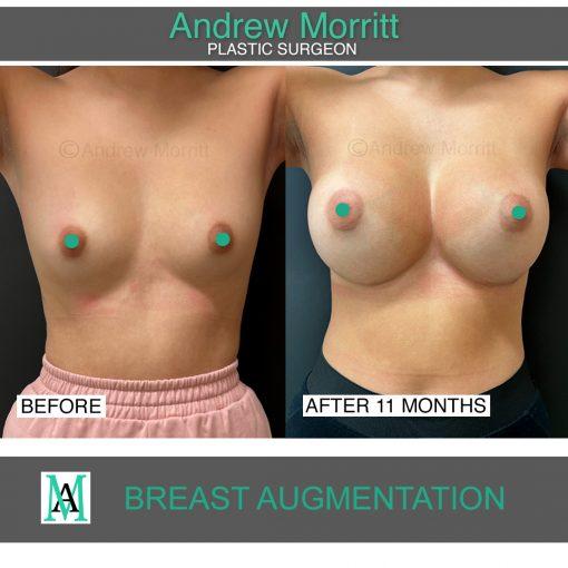 breast augmentation