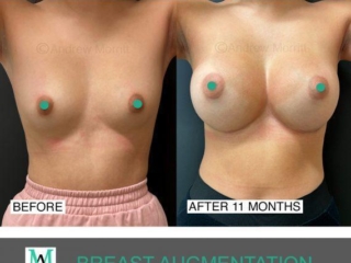 breast-augmentation-22 Before and after breast augmentation