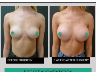 breast augmentation enlargement sheffield 1 breast augmentation enlargement sheffield 1