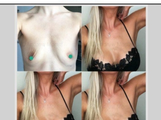 breast augmentation enlargement sheffield breast augmentation enlargement sheffield