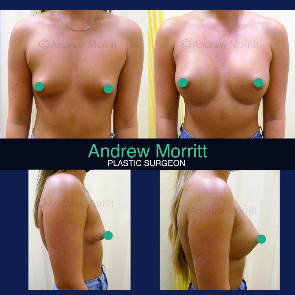 breast augmentation enlargement sheffield 12 breast augmentation enlargement sheffield