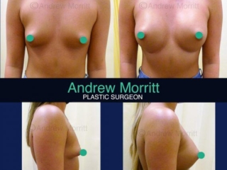 breast augmentation enlargement sheffield 12 breast augmentation enlargement sheffield