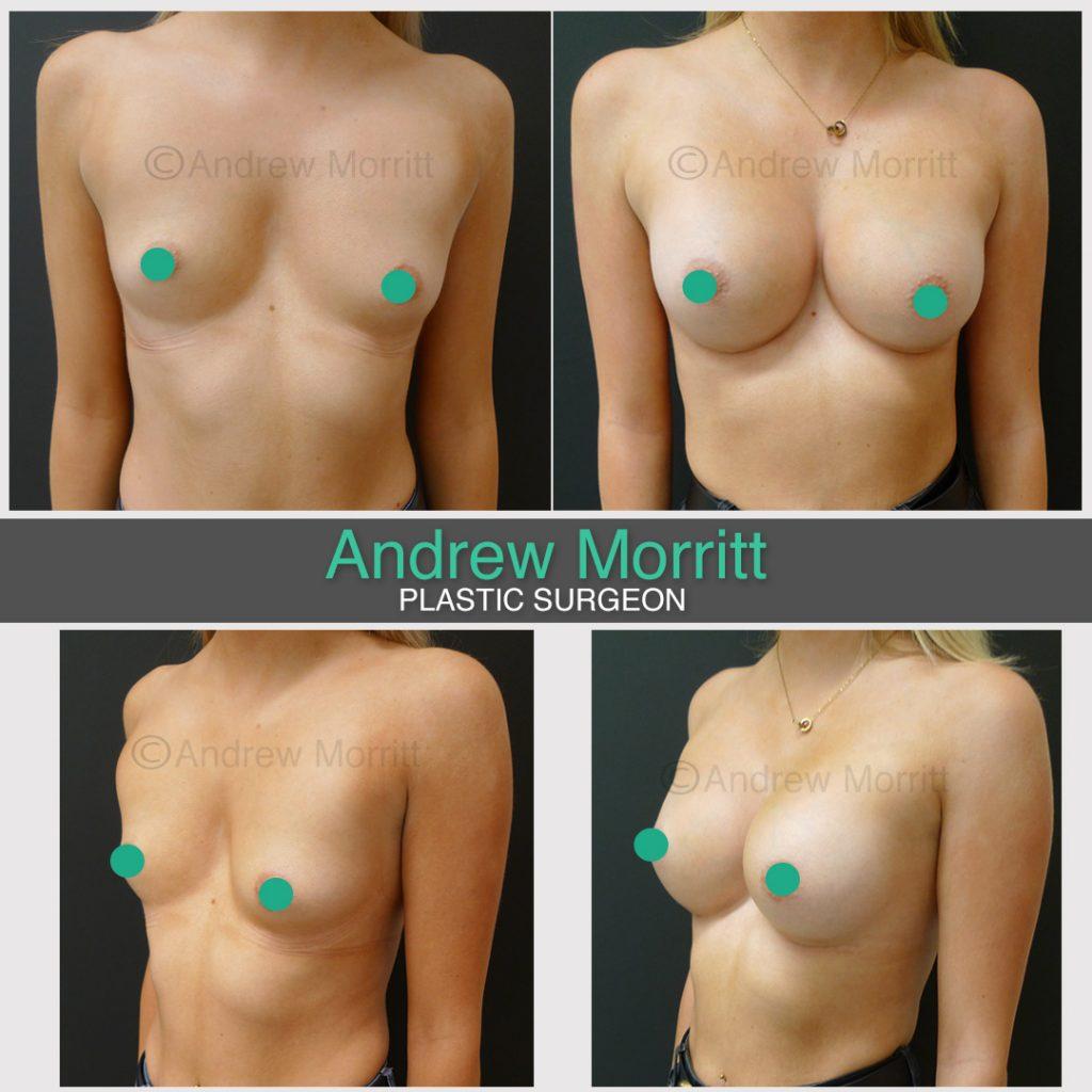 breast augmentation enlargement sheffield teardrop breast augmentation enlargement teardrop sheffield