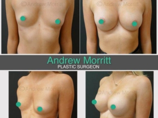 breast augmentation enlargement sheffield teardrop breast augmentation enlargement teardrop sheffield