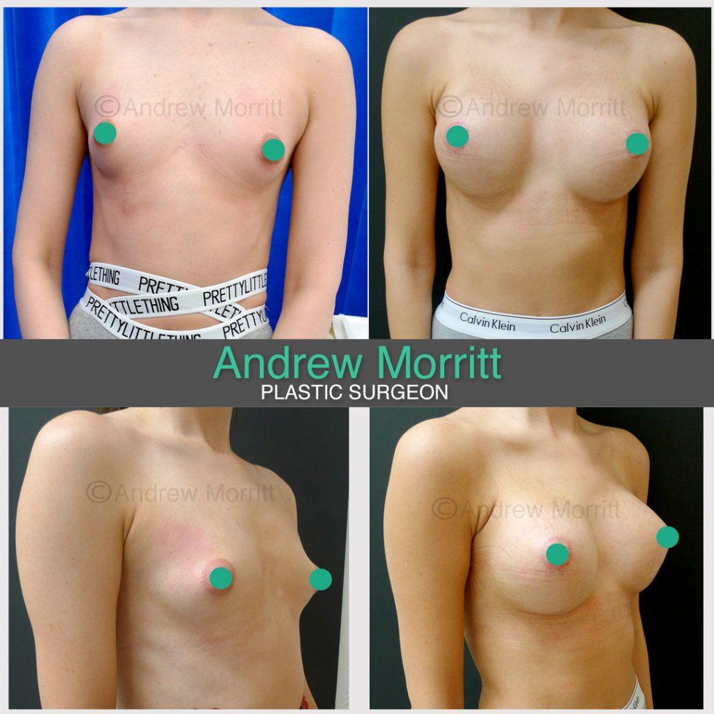 breast augmentation enlargement sheffield 13 breast augmentation enlargement sheffield