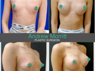 breast augmentation enlargement sheffield 13 breast augmentation enlargement sheffield