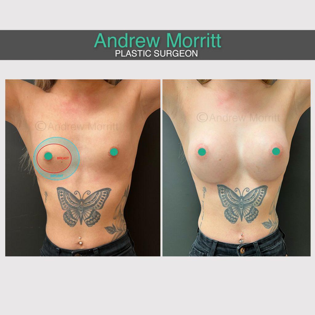 breast augmentation enlargement sheffield 10 breast augmentation enlargement sheffield