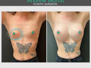 breast augmentation enlargement sheffield 10 breast augmentation enlargement sheffield