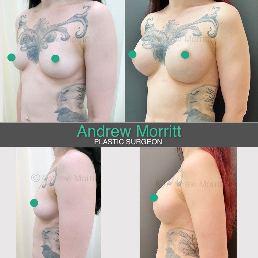 breast augmentation enlargement sheffield 9 breast augmentation enlargement sheffield