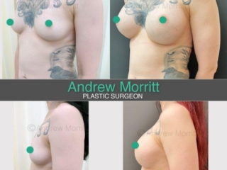 breast augmentation enlargement sheffield 9 breast augmentation enlargement sheffield