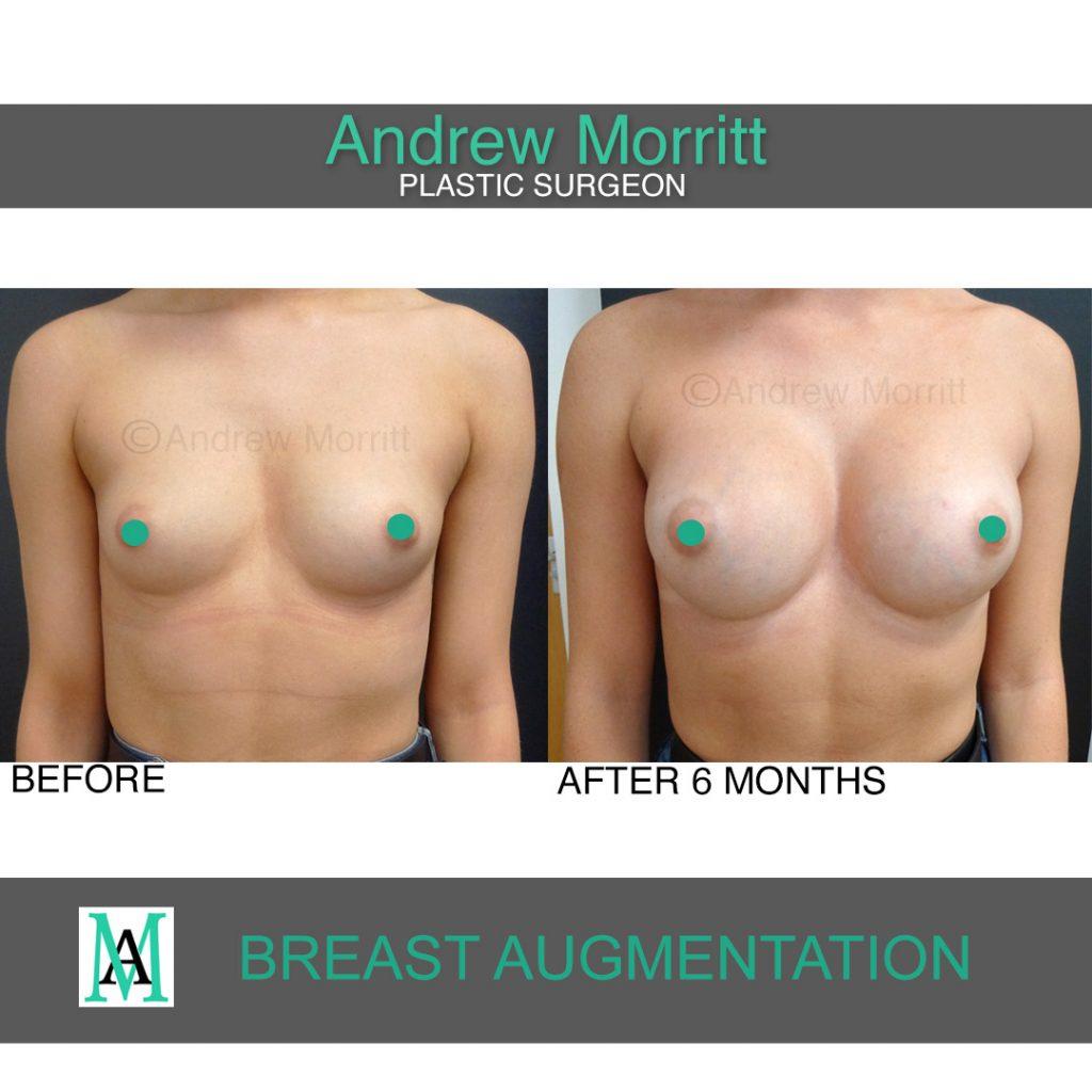breast augmentation enlargement sheffield 6 breast augmentation enlargement sheffield