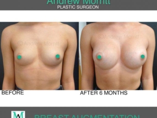 breast augmentation enlargement sheffield 6 breast augmentation enlargement sheffield