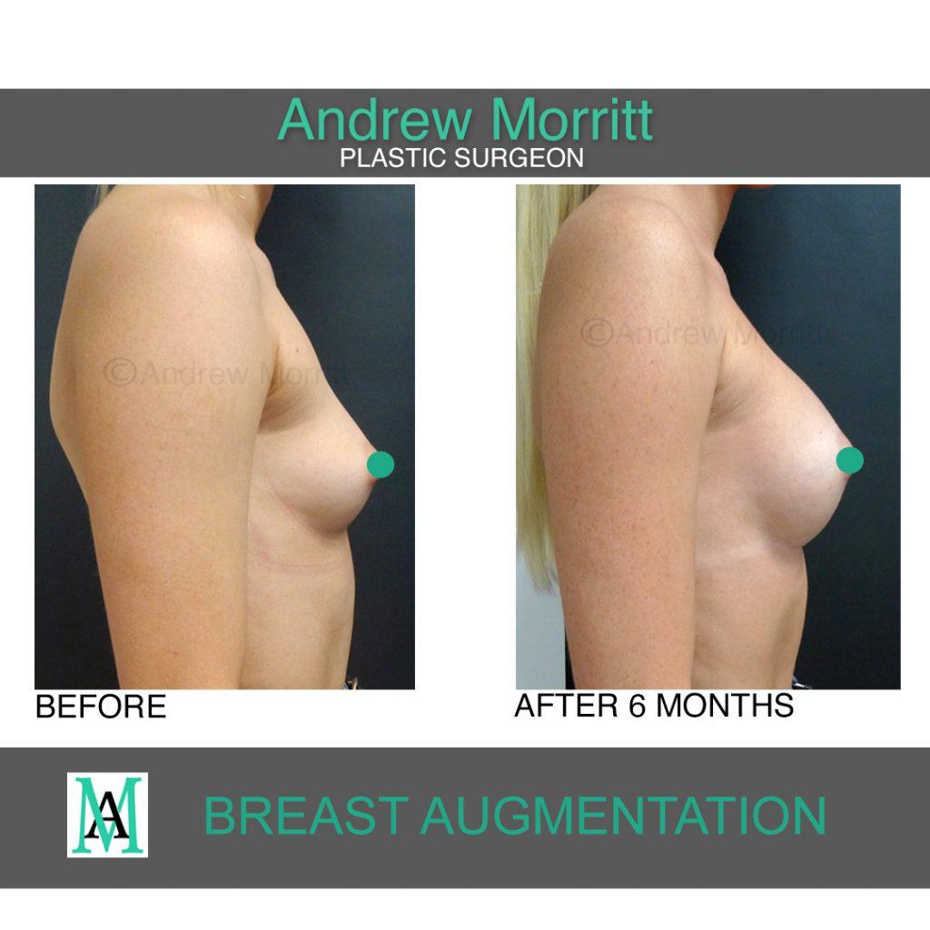breast augmentation enlargement sheffield 7 breast augmentation enlargement sheffield