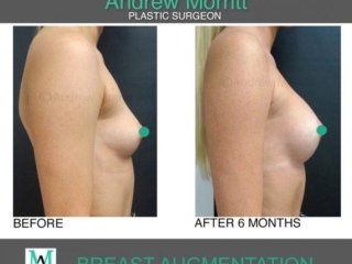 breast augmentation enlargement sheffield 7 breast augmentation enlargement sheffield
