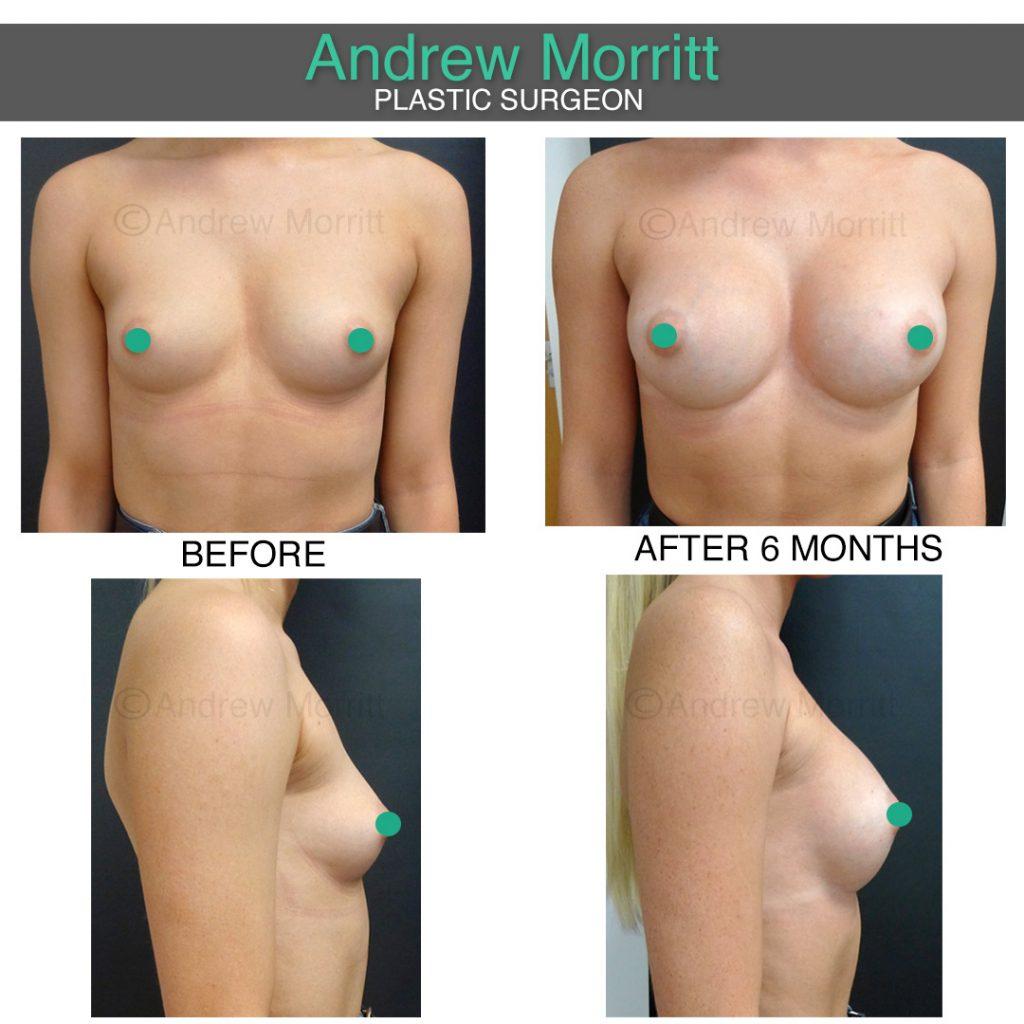 breast augmentation enlargement sheffield 8 breast augmentation enlargement sheffield
