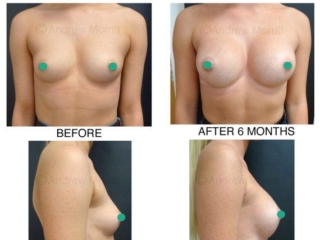 breast augmentation enlargement sheffield 8 breast augmentation enlargement sheffield