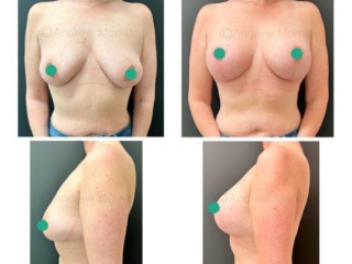 breast augmentation enlargement uplift sheffield breast augmentation enlargement uplift sheffield