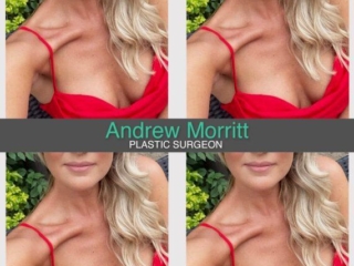 breast augmentation enlargement sheffield 18 breast augmentation enlargement sheffield