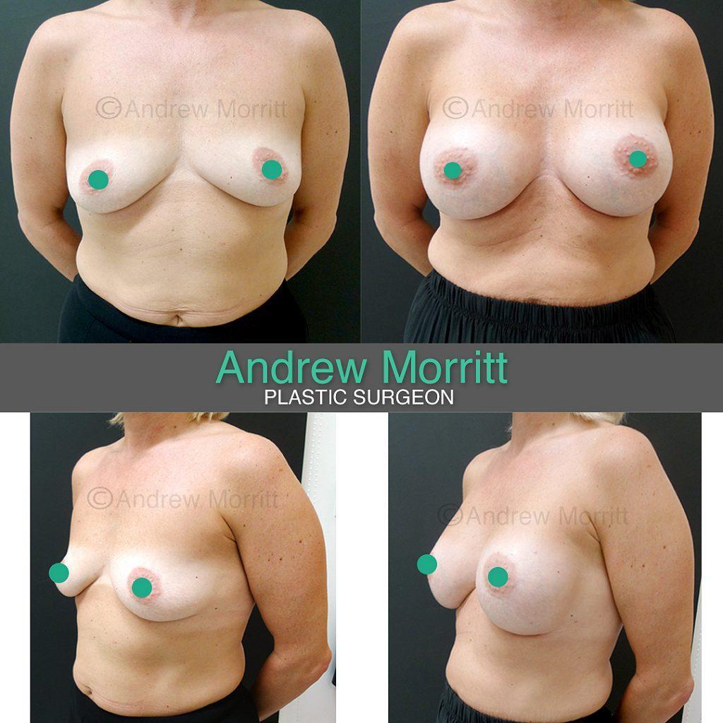 breast-augmentation-before-after20 Before and after breast augmentation