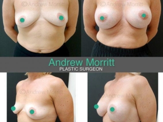 breast-augmentation-before-after20 Before and after breast augmentation