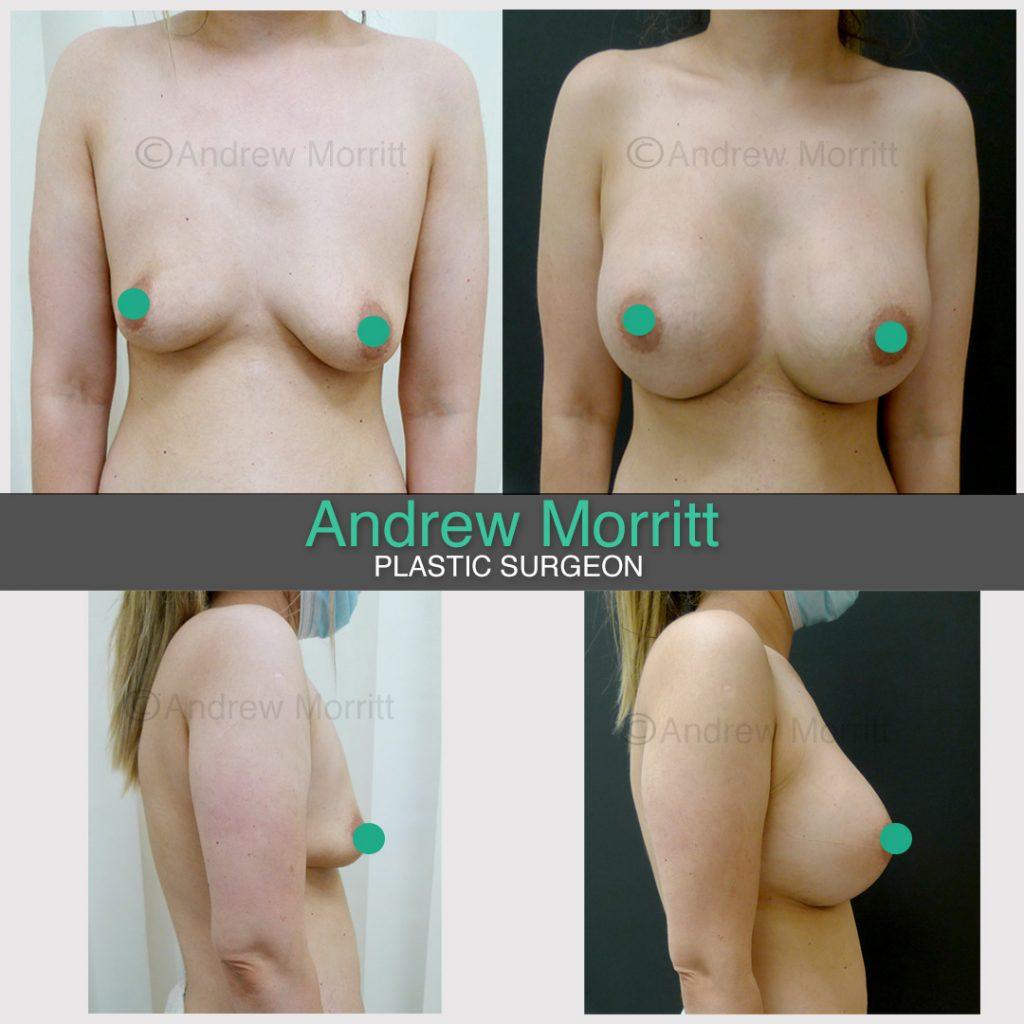 breast augmentation enlargement sheffield 11 breast augmentation enlargement sheffield