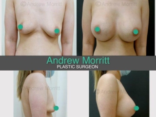breast augmentation enlargement sheffield 11 breast augmentation enlargement sheffield