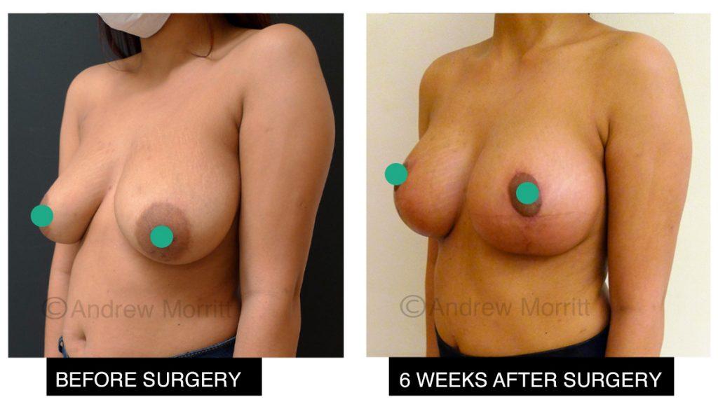 breast augmentation enlargement uplift sheffield 3 breast augmentation enlargement uplift sheffield
