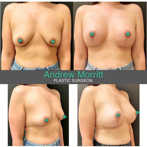 breast augmentation and uplift