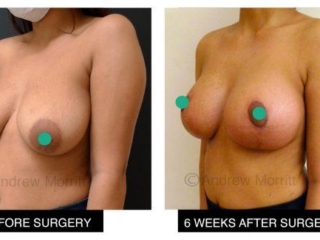 breast augmentation enlargement uplift sheffield 3 breast augmentation enlargement uplift sheffield