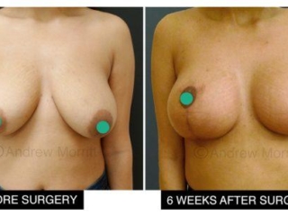 breast augmentation enlargement uplift sheffield 2 breast augmentation enlargement sheffield