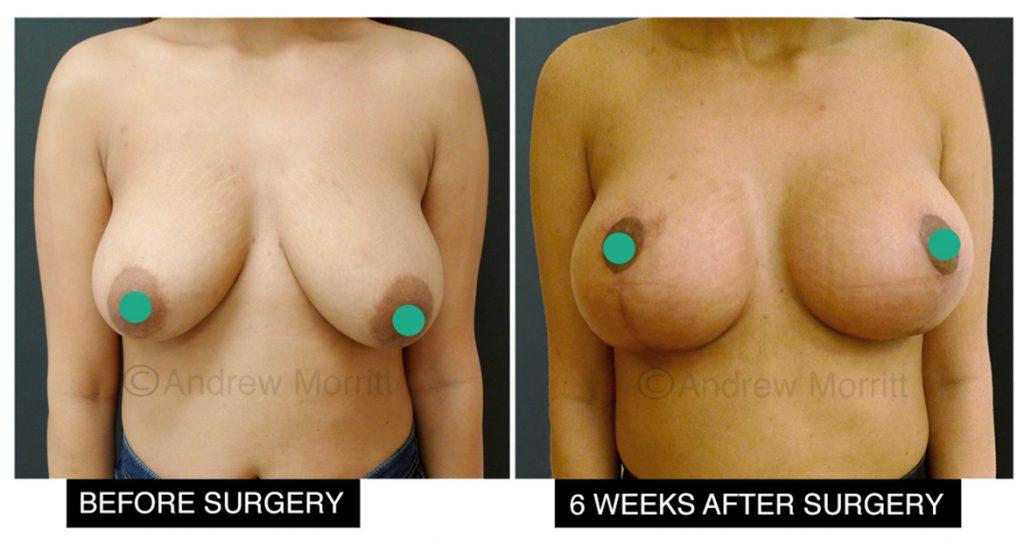 breast augmentation enlargement uplift sheffield