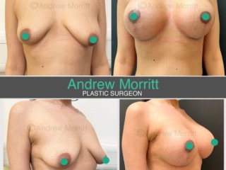 breast augmentation enlargement uplift sheffield