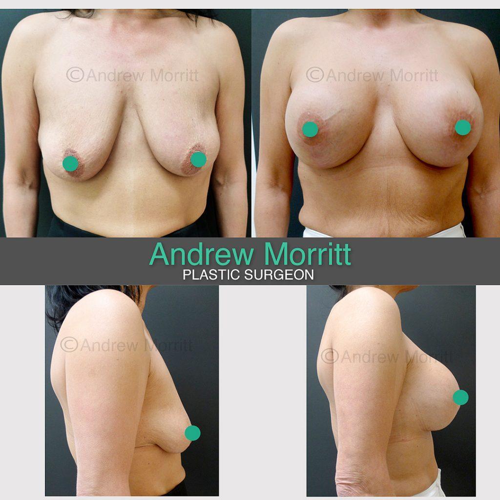 breast augmentation enlargement uplift sheffield
