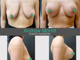 breast augmentation enlargement uplift sheffield