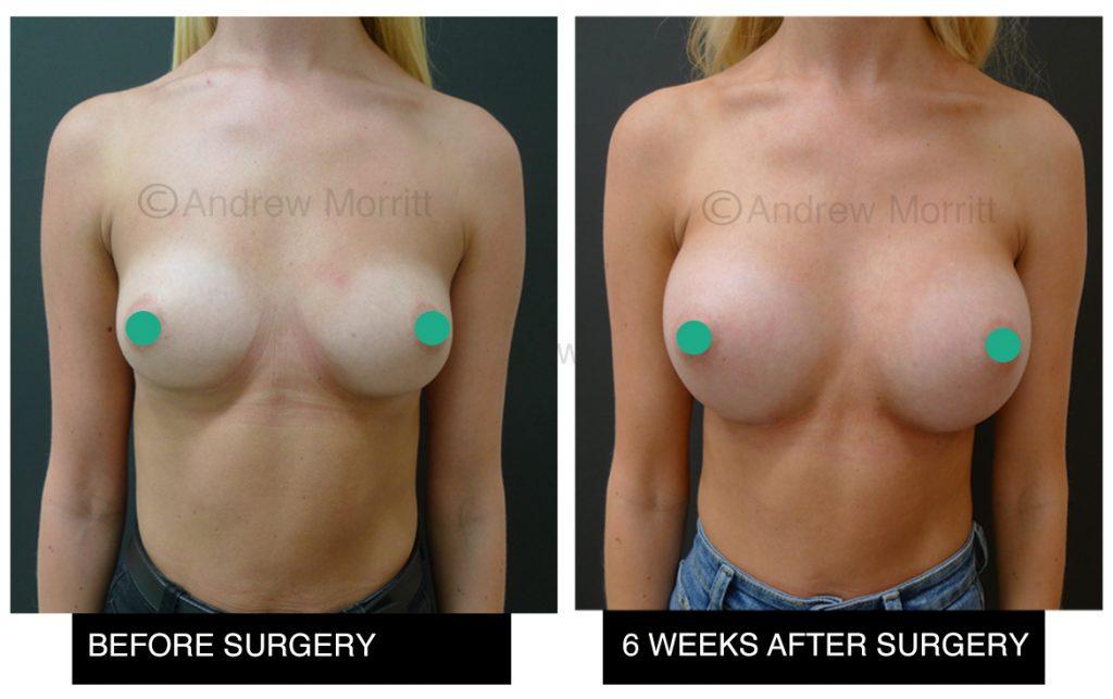 breast augmentation enlargement sheffield 15 breast augmentation enlargement sheffield