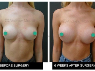 breast augmentation enlargement sheffield 15 breast augmentation enlargement sheffield