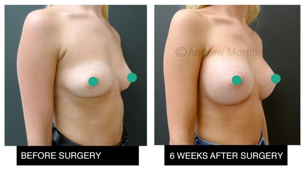 breast augmentation enlargement sheffield 16 breast augmentation enlargement sheffield