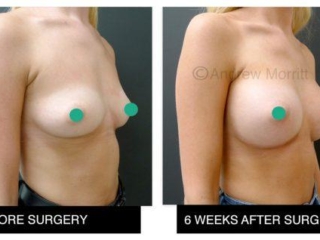 breast augmentation enlargement sheffield 16 breast augmentation enlargement sheffield