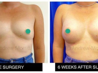 breast augmentation enlargement sheffield 14 breast augmentation enlargement sheffield
