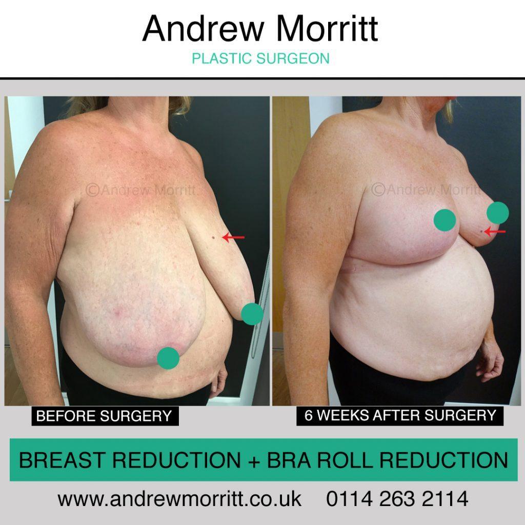 Breast reduction Breast reduction