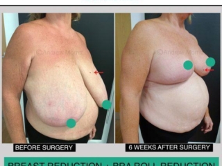 Breast reduction