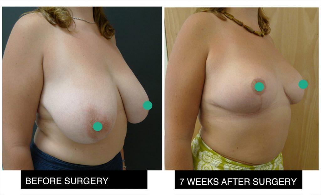 Breast reduction Breast reduction