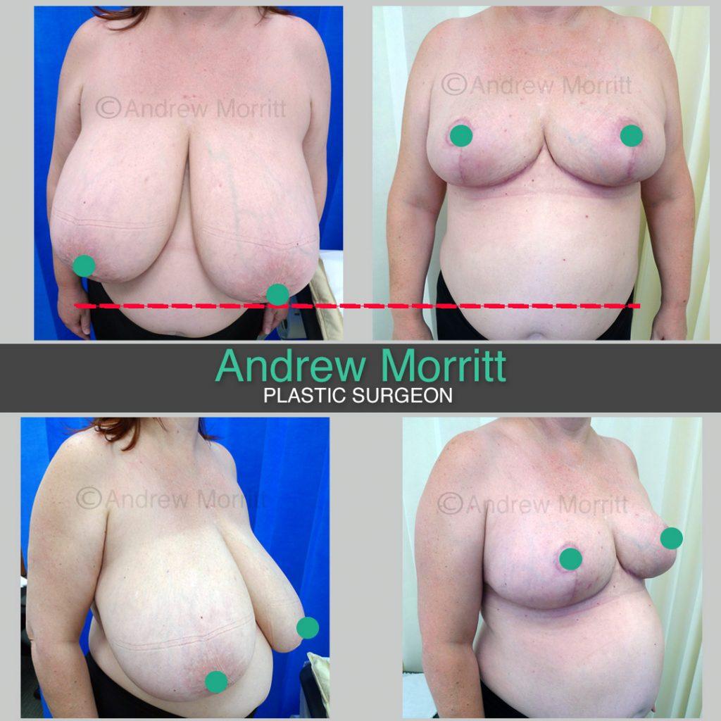 Breast reduction Breast reduction