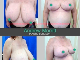 Breast reduction