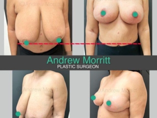 Breast reduction